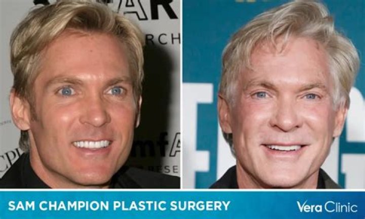 Sam Champion Plastic Surgery: Champion's Hair Transplant Behind His Timeless Looks!
